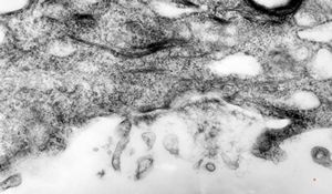 M, 1y. | epidermolysis bullosa … junctional type M, 1y. | epidermolysis bullosa … junctional type